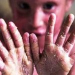 درخواست «خانه ای‌بی» از بنیاد بیماری‌های خاص فهرست خدمات قابل ارایه به بیماران ای‌بی را اعلام کنید