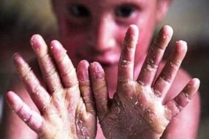 Read more about the article خانه ای‌بی خواستار شفاف‌سازی خدمات درمانی بیماران ای‌بی شد