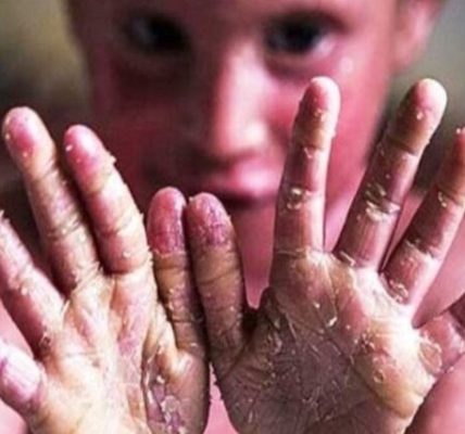 درخواست «خانه ای‌بی» از بنیاد بیماری‌های خاص فهرست خدمات قابل ارایه به بیماران ای‌بی را اعلام کنید