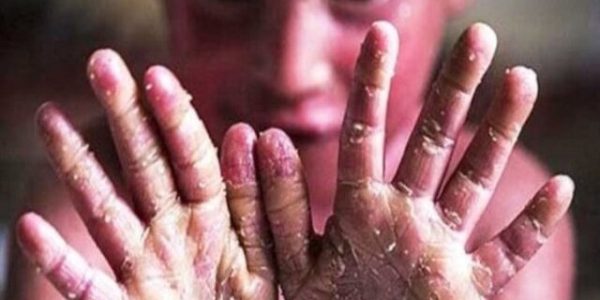 درخواست «خانه ای‌بی» از بنیاد بیماری‌های خاص فهرست خدمات قابل ارایه به بیماران ای‌بی را اعلام کنید